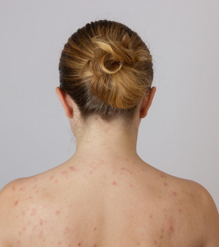 Blowjob In Film Adult Acne On Back