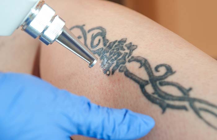 How To Remove Permanent Tattoos: 4 Surgical Methods And 6 DIYs