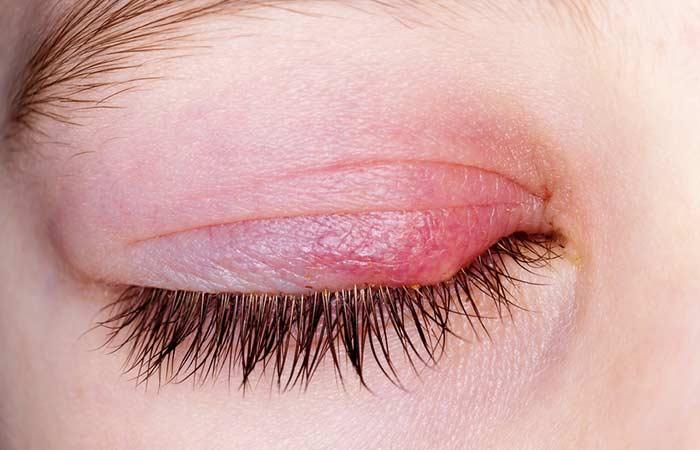 12 Simple Treatments For Dandruff On Eyelashes And Eyebrows