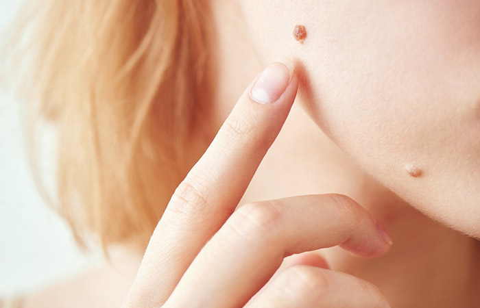 10 Best Essential Oils for Mole Removal: Which Oil is Good for Skin Mo