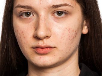 11 Best Home Remedies To Get Rid Of Facial Scars Naturally
