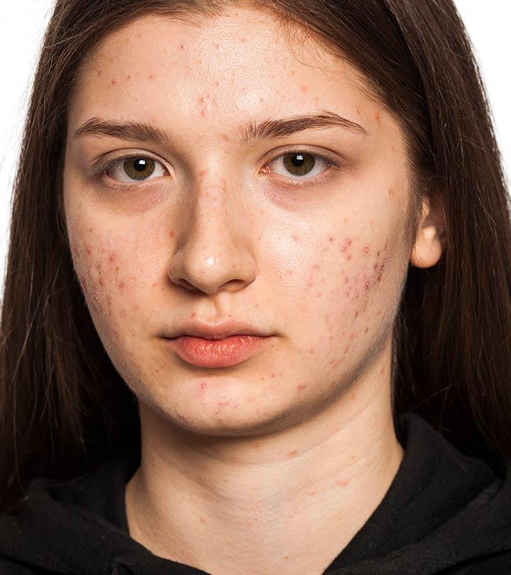 How to Get Rid of Scars for Good