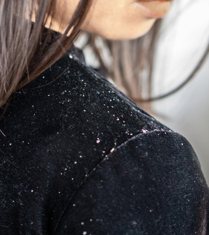 How To Get Rid Of Dandruff Naturally – 18 Tips And Remedies