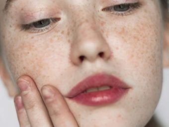 3 Ways To Treat Hyperpigmentation And Tips To Prevent It