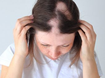 Alopecia Areata Hair Loss – Causes, Symptoms, & Treatments