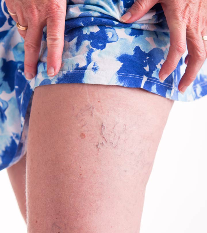 19 Home Remedies To Improve Spider Veins Naturally