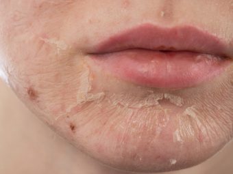 Skin Peeling: Causes, Symptoms, And How To Reduce It