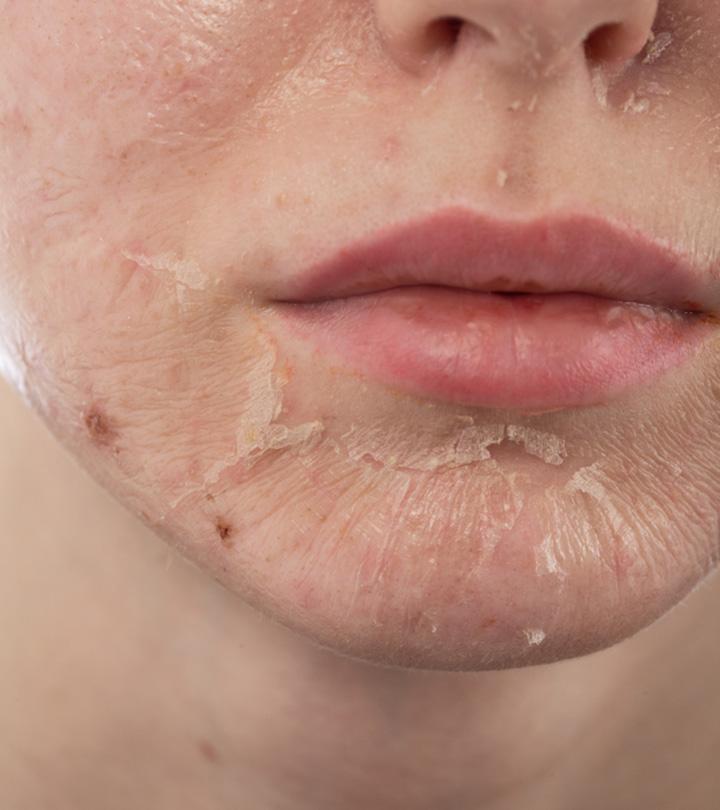 Skin Peeling: Causes, Symptoms, And How To Reduce It