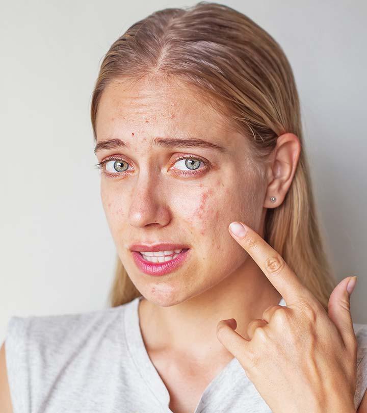 5 Best Home Remes For Cystic Acne