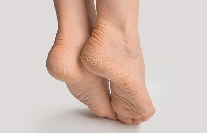How to Treat Dry, Cracked Heel? → See the Ultimate Guide Here