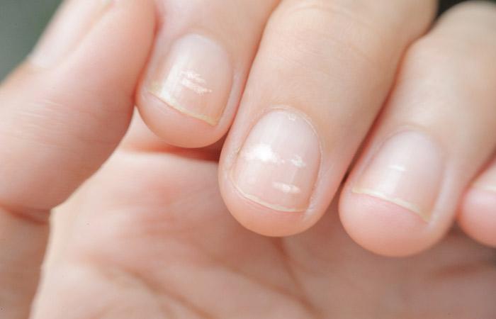Common Nail Conditions: Is It a Sign of Vitamin Deficiency? | Nature's Best