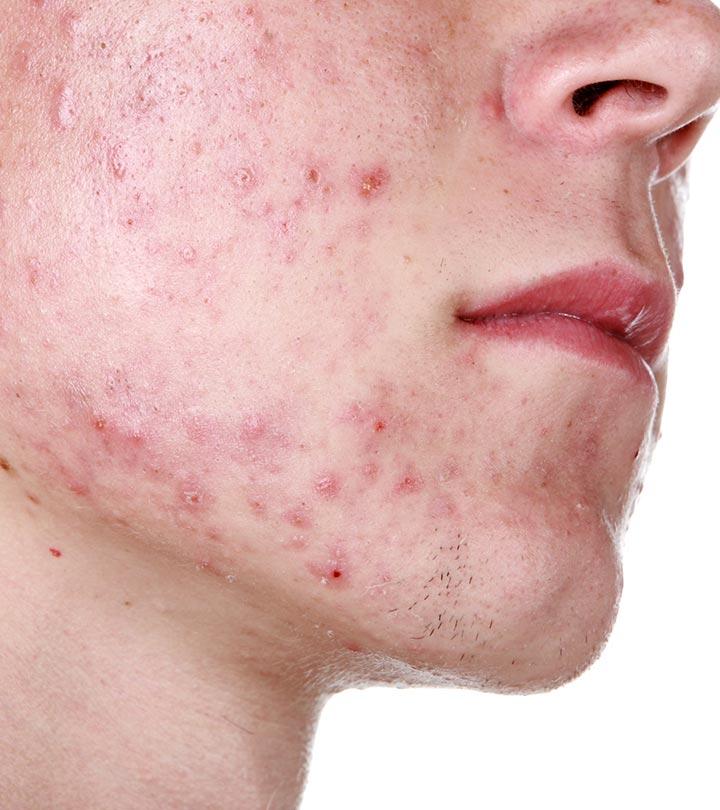 Adult-Acne-–-Types,-Causes,-Treamtment-And-Care
