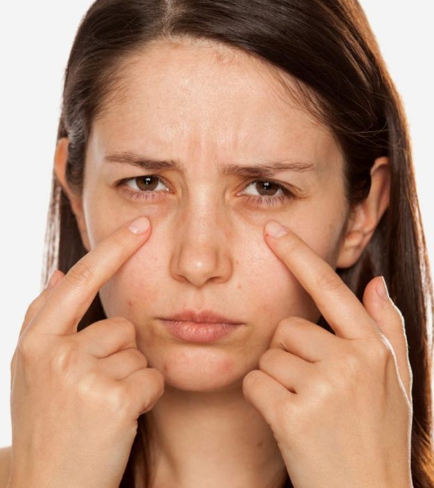 How To Treat Dark Circles Under Eyes: Causes, Home Remedies, And More