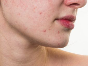 6 Natural Ways To Treat Red Spots On Skin And Prevention Tips