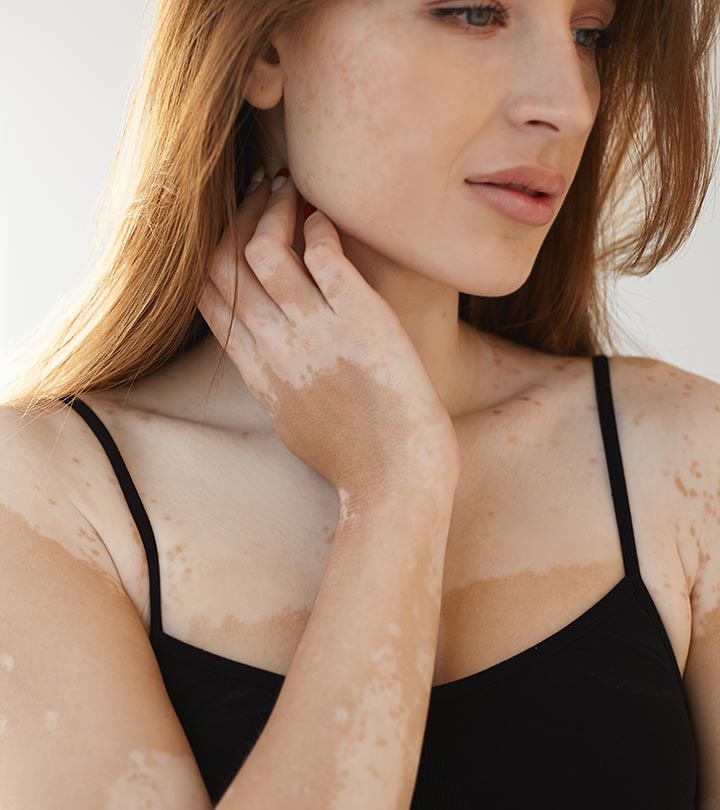 White Spots On Skin (Vitiligo) – Causes, Symptoms, & Remedies