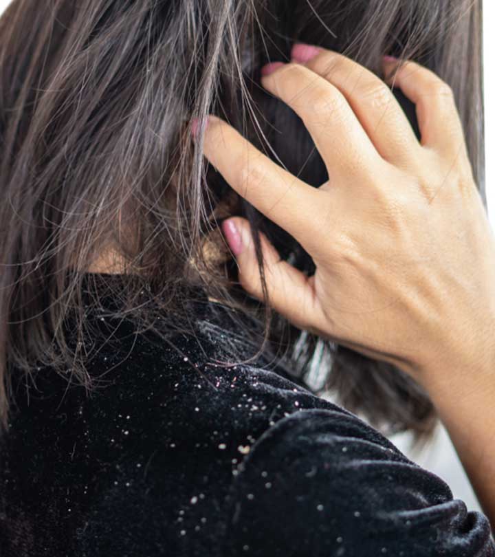 7 Best Hair Oils For Dandruff – Control The Itching & Flaking
