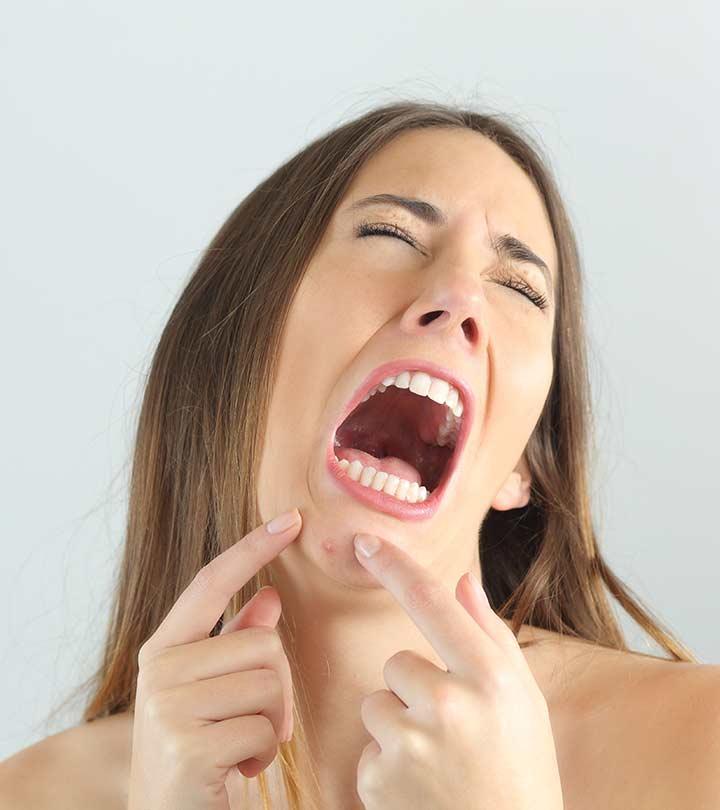 Chin Acne & Pimples: Causes, Treatment, And Skin Care Tips