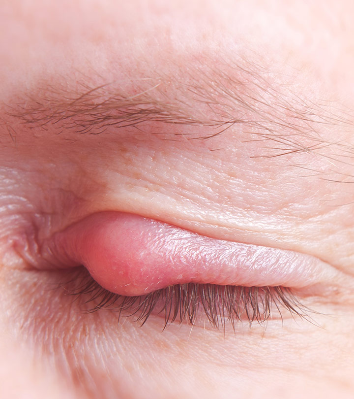 How To Remove Pimples On Eyelids?