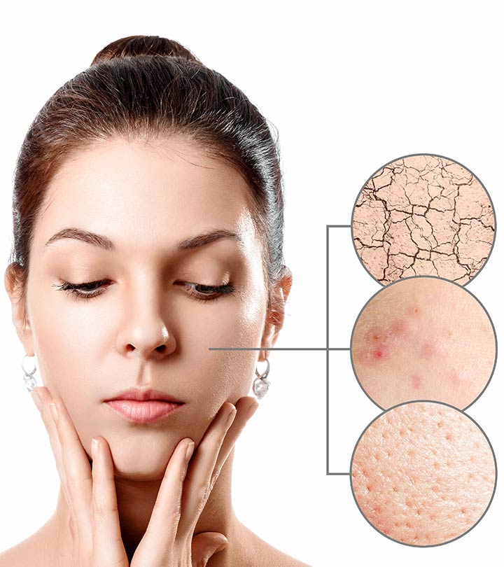 Dry Skin Acne: 12 Home Remedies And Tips To Prevent It