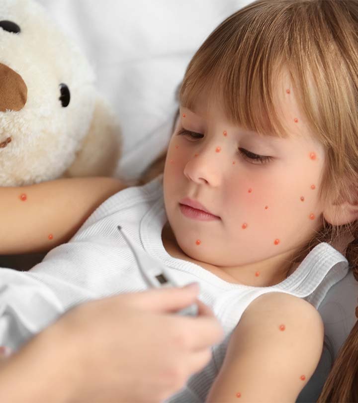 Top 16 Effective Home Remedies To Get Rid Of Chickenpox