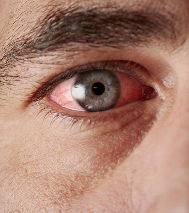 Top-10-Home-Remedies-To-Get-Relief-From-Pink-Eye