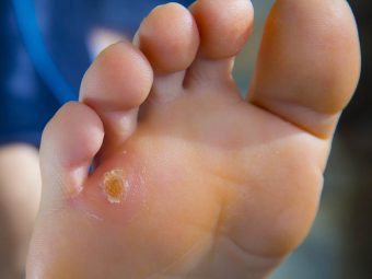 19 Best Home Remedies For Corns And Calluses, FAQs, & Caution