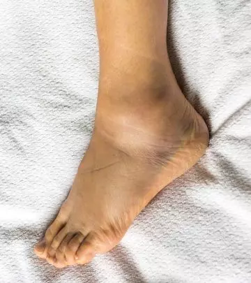 17 Home Remedies For Swollen Feet, Symptoms, And Treatments