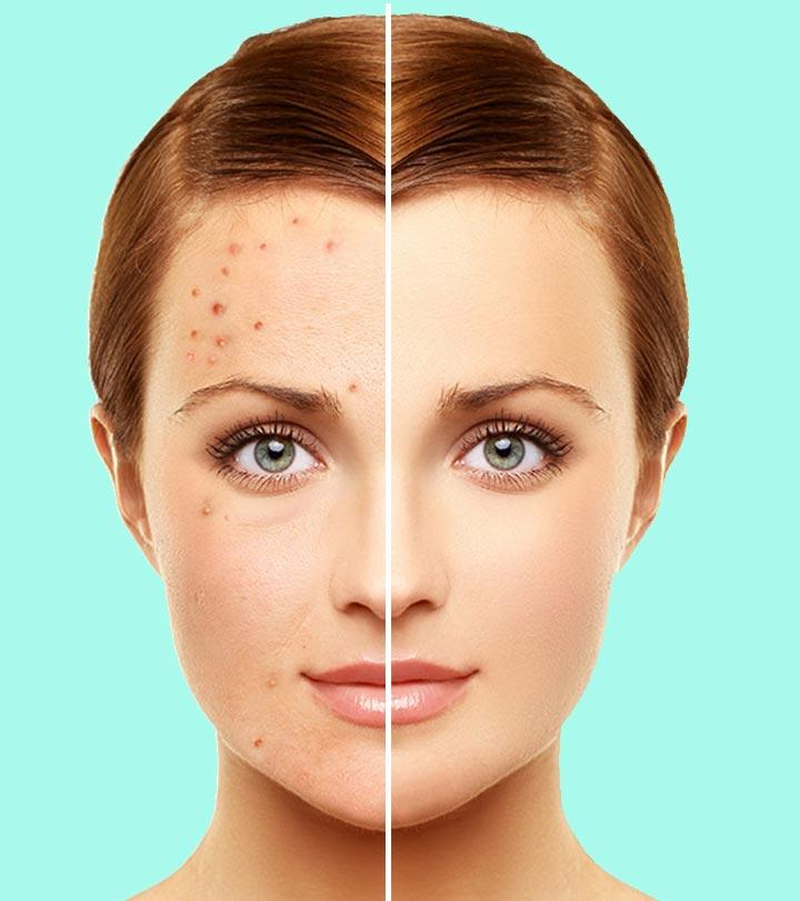 Home-Remedies-For-Rosacea
