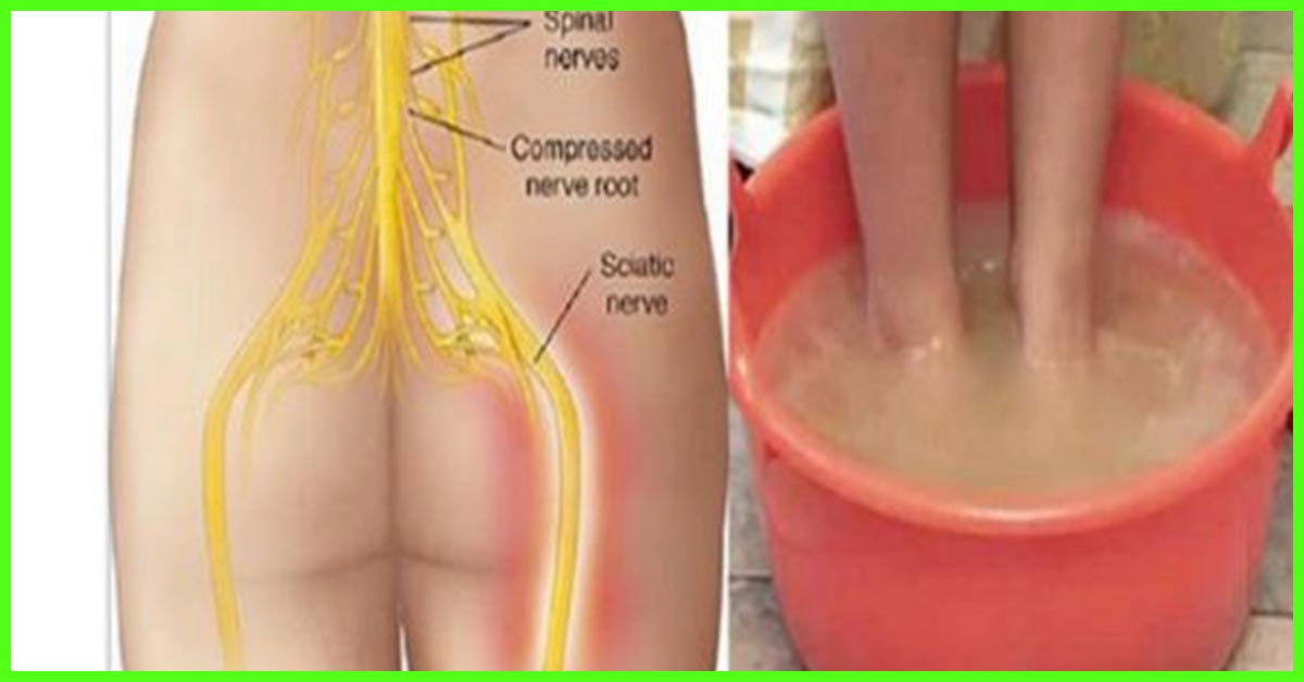 16 Effective Home Remedies To Relieve Sciatic Nerve Pain 1