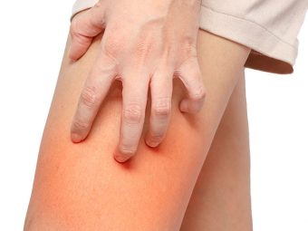 Home Remedies For Chafing: 14 Natural Ways To Protect Your Skin