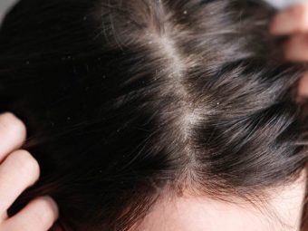 10-Best-Home-Remedies-For-Dry-Scalp-And-Prevention-Tips