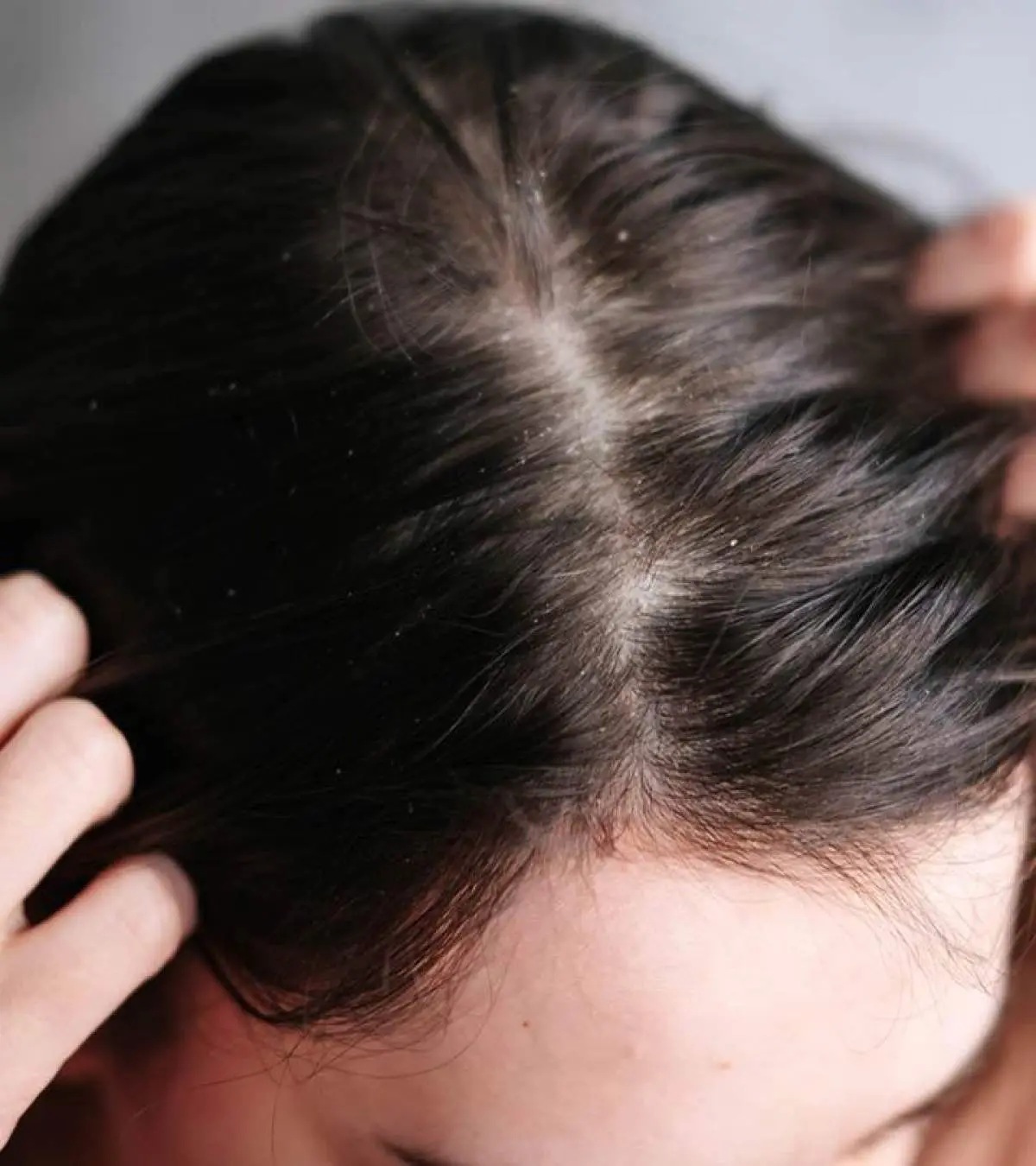 How To Get Rid Of Dry Scalp: 10 Natural Home Remedies