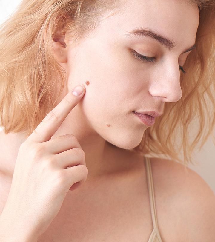 10 Best Mole Removal Creams Available In India – 2023
