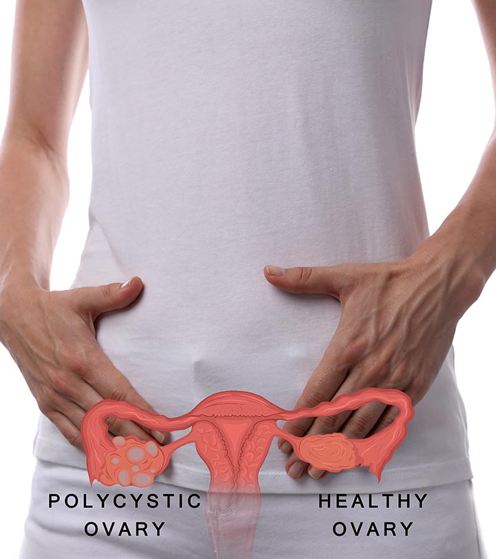 17 Home Remedies For Polycystic Ovary Syndrome (PCOS) + Prevention Tips (Foods To Avoid)