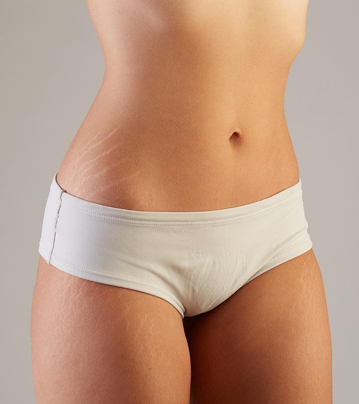 9 Simple Ways To Use Castor Oil For Treating Stretch Marks