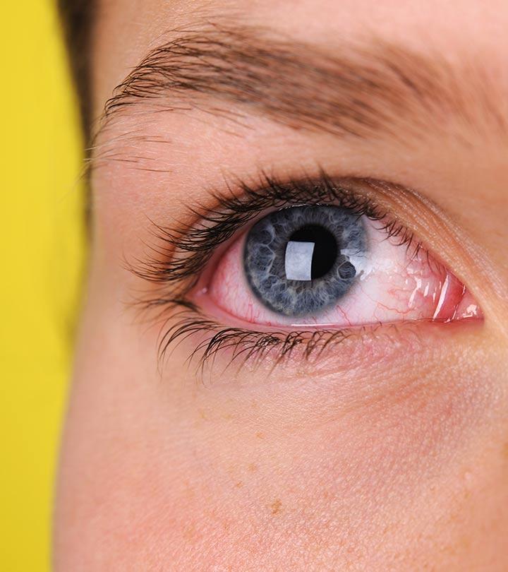 Welder's Flash Burn Or Arc Eye Natural Treatment – 10 Home ...