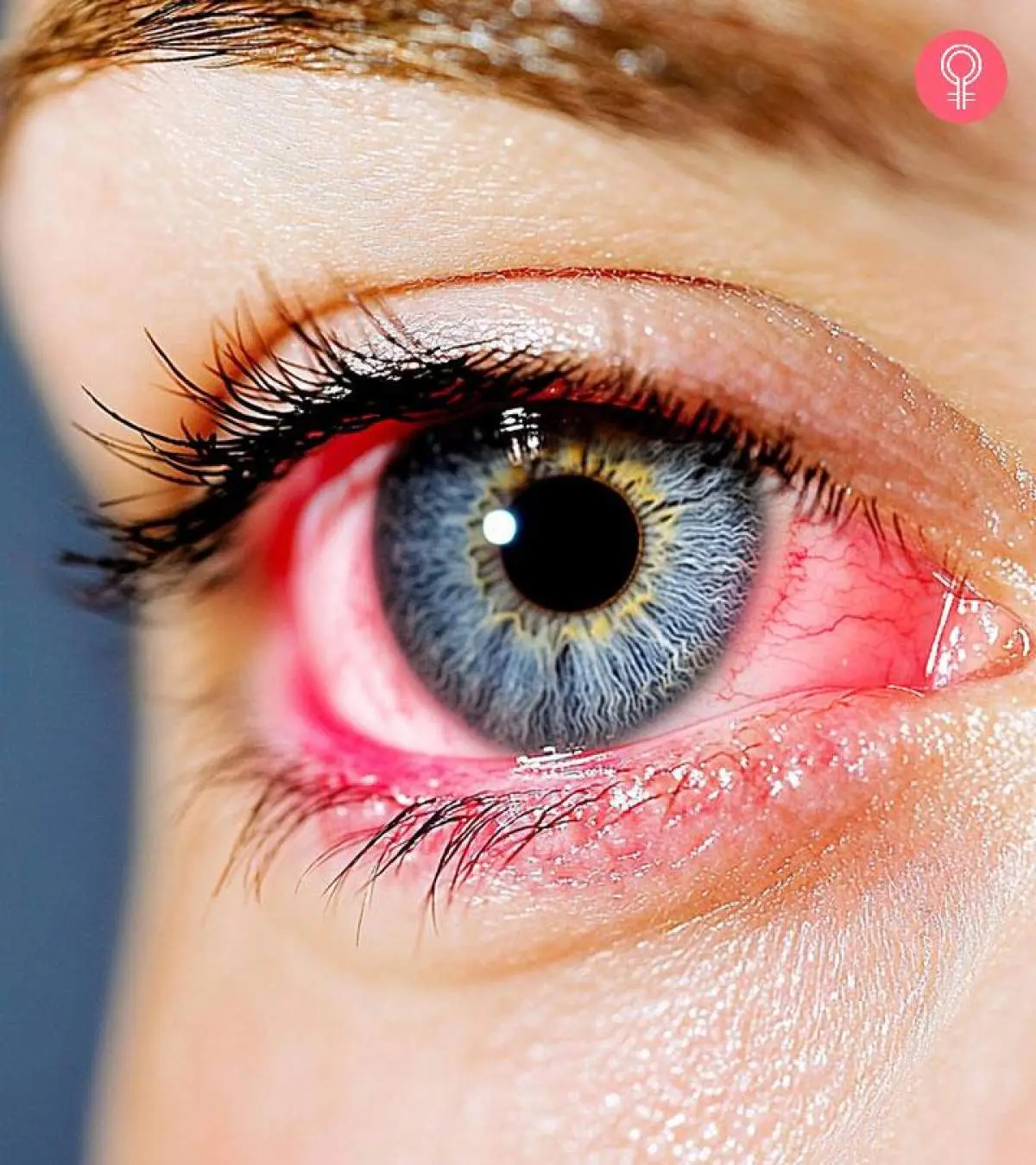 10 Home Remedies To Treat Welder’s Flash Burn Eyes