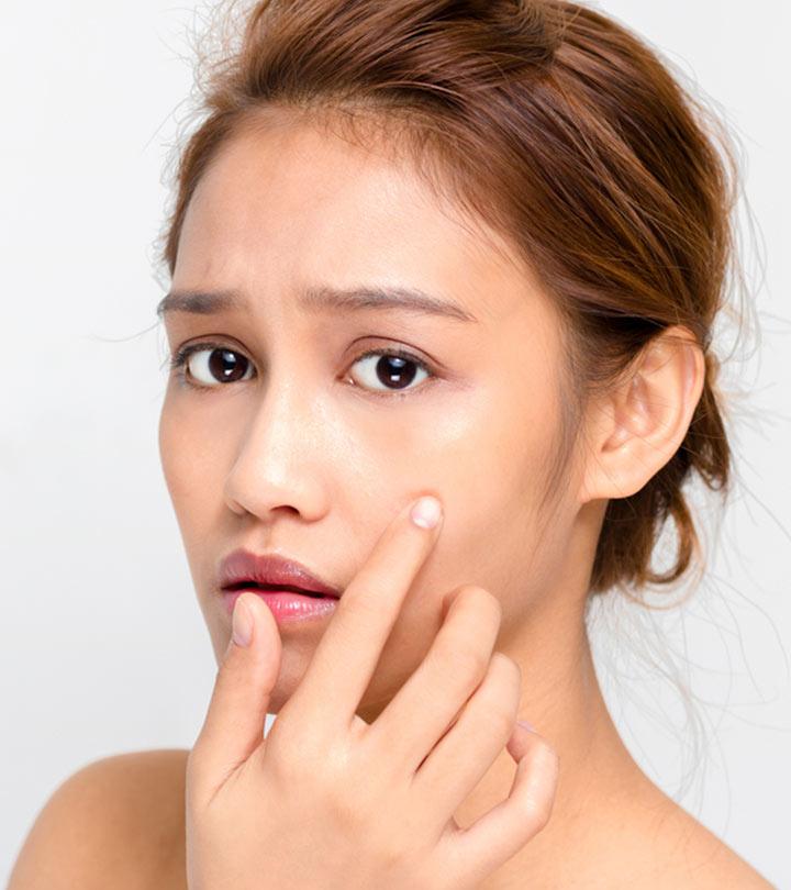 Mederma for acne scars deals