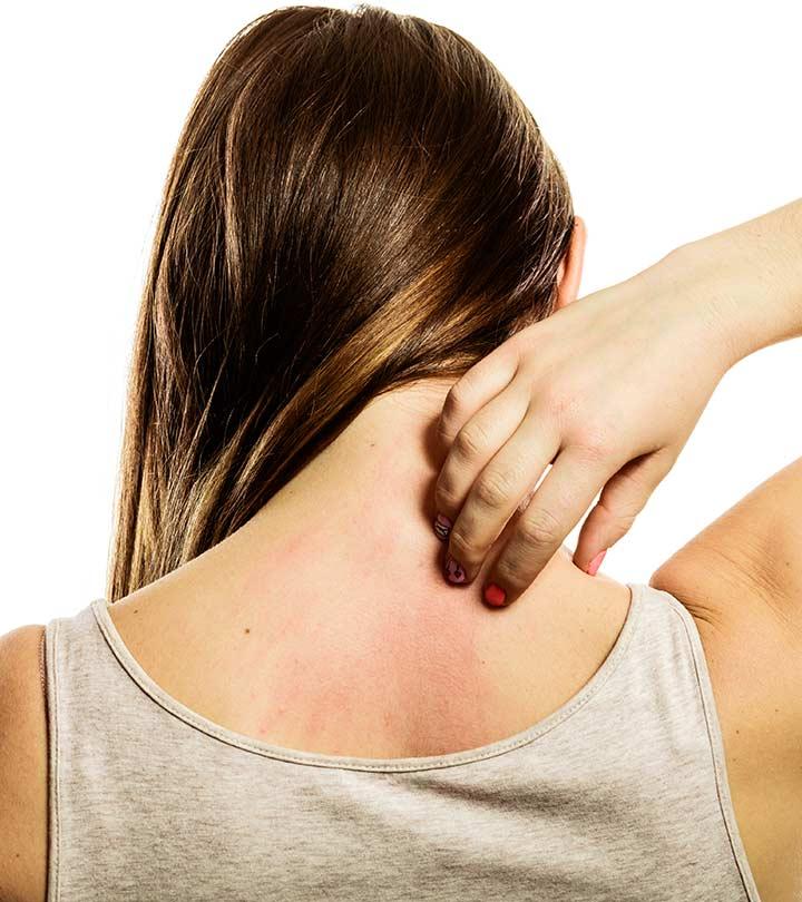 How to get rid of heat rash: Relieve redness and itchiness by