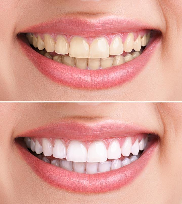 Hydrogen Peroxide For Teeth Whitening – 6 Home Remedies