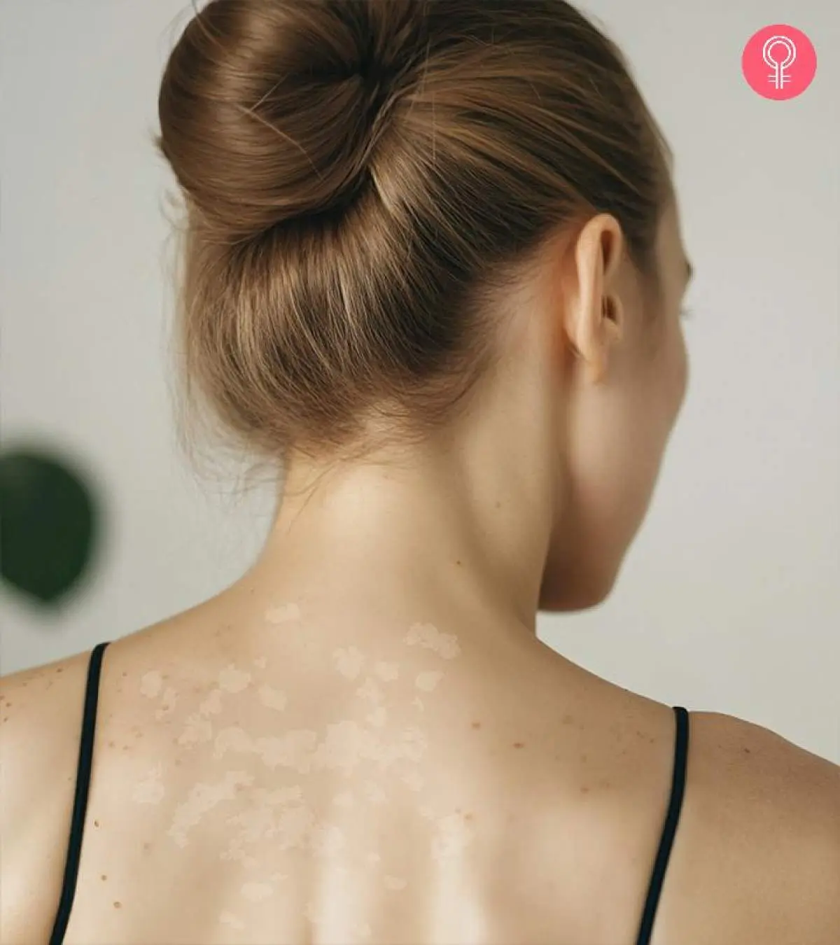 15 Home Remedies To Treat Tinea Versicolor