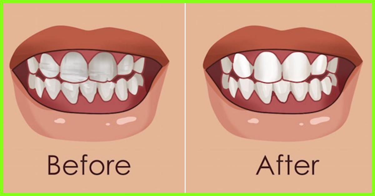 How to strengthen loose teeth causes and home remedies