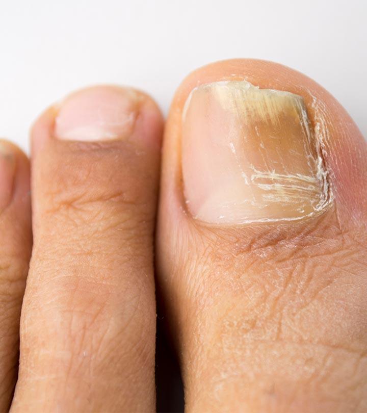 Topical Treatments Options for Toenail Fungus