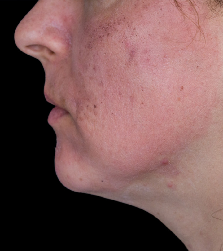 How To Deal With Flushing & Redness From Rosacea