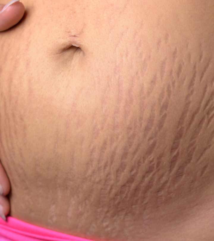 Rub This Oil On Your Stretch Marks And They Will Disappear In 30 Days