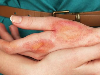 How To Treat Burns At Home - 14 Natural Remedies To Try