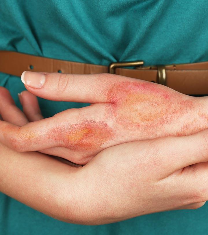 What to put on burn blisters store