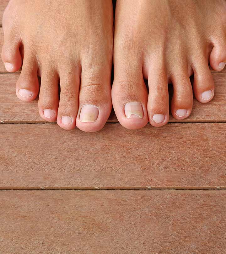 Home Remedies For Burning Feet: Treat Burning Sensation In Feet With Home  Remedies | Livlong