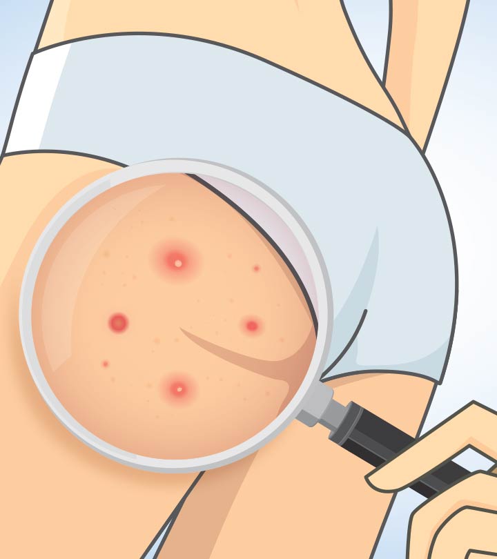 Home Remedies To Get Rid Of Butt Acne And Prevention Tips