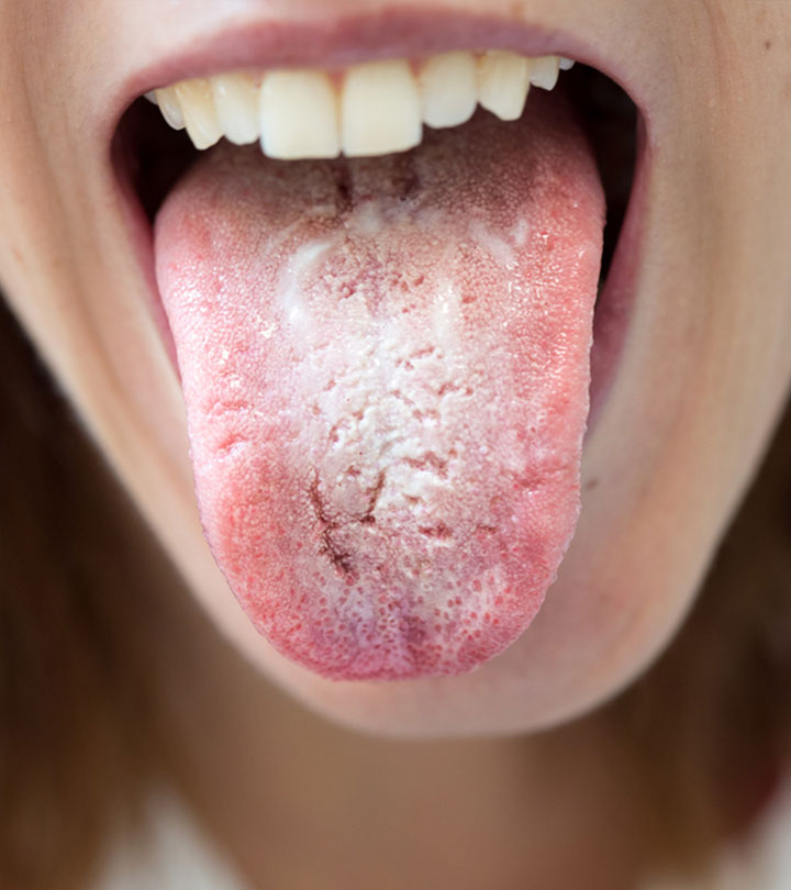 10 Ways To Get Rid Of White Tongue And Make It Healthier